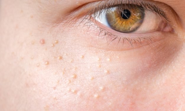 Here’s How To Get Rid Of Milia Bumps Without Visiting the Derm
